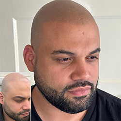 Een geschoren look behandeling