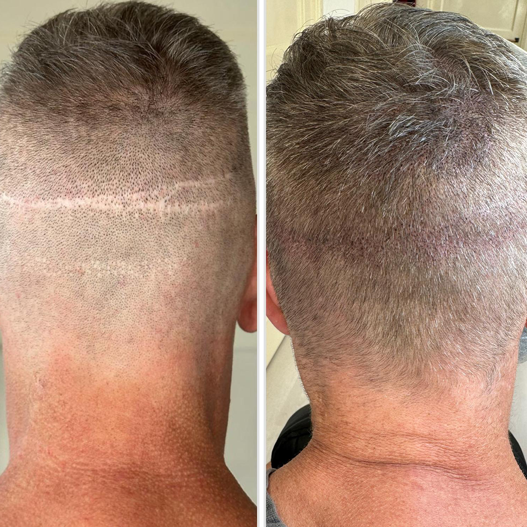 behandelingen litteken cammouflage