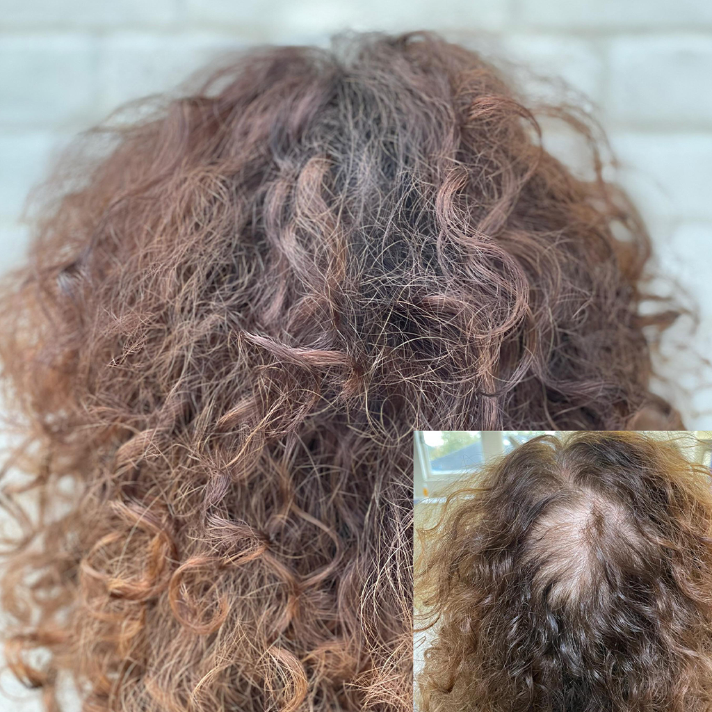 behandelingen volumebehandeling